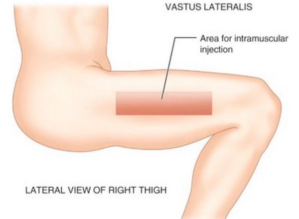 محل تزریق ترنبولون در عضله خارجی ران
