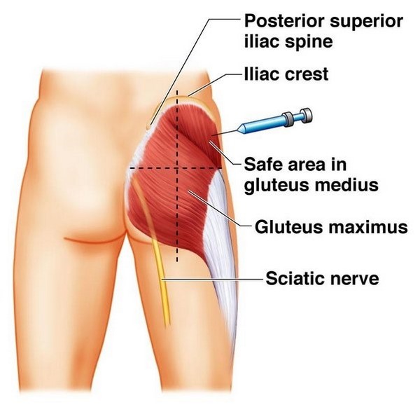 محل تزریق استروئید در عضله ربع خارجی ران